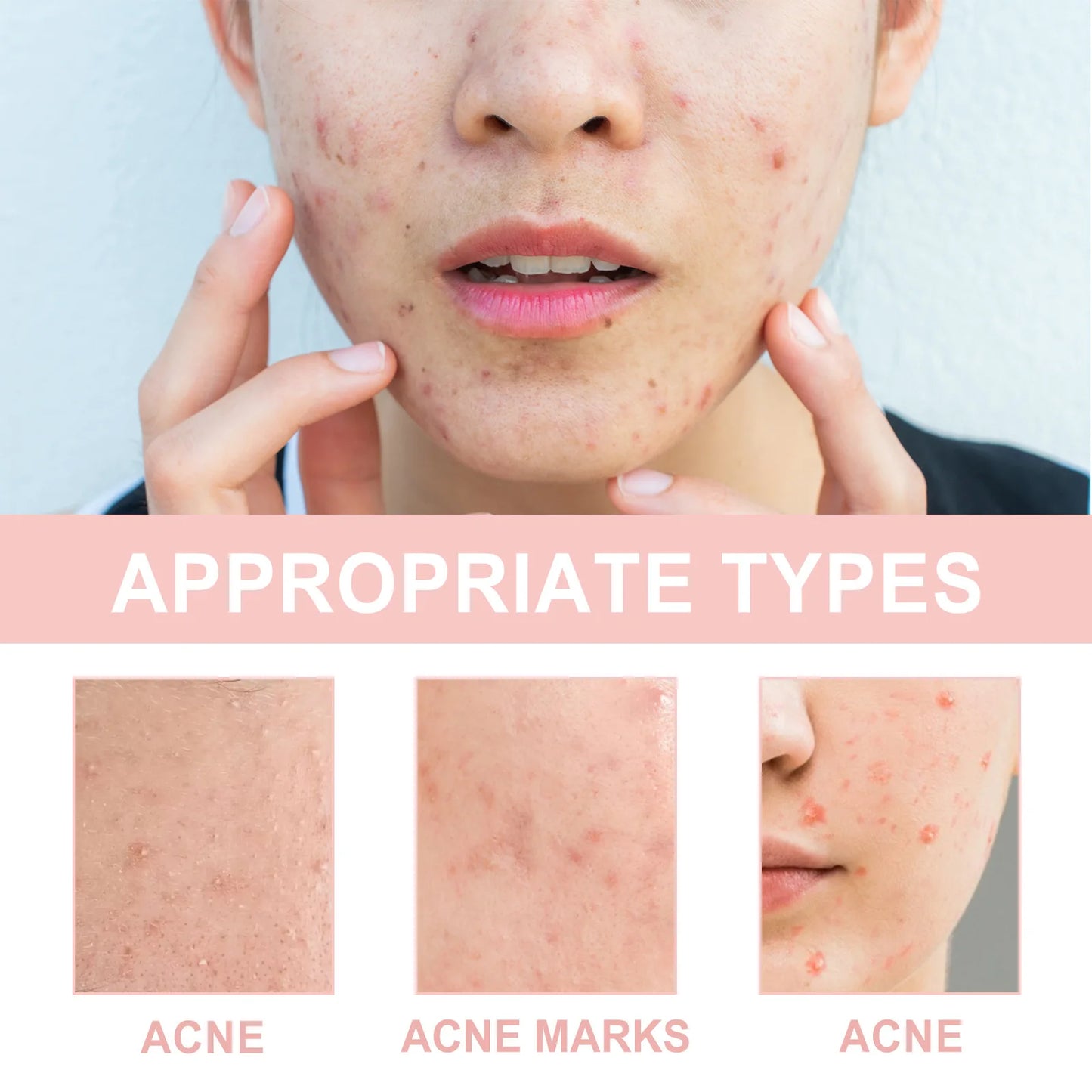Face Patches for Pimples Microneedles Drying Patch Blemish Covering Stickers 72 Count Invisible Spot Care Absorbing All Day