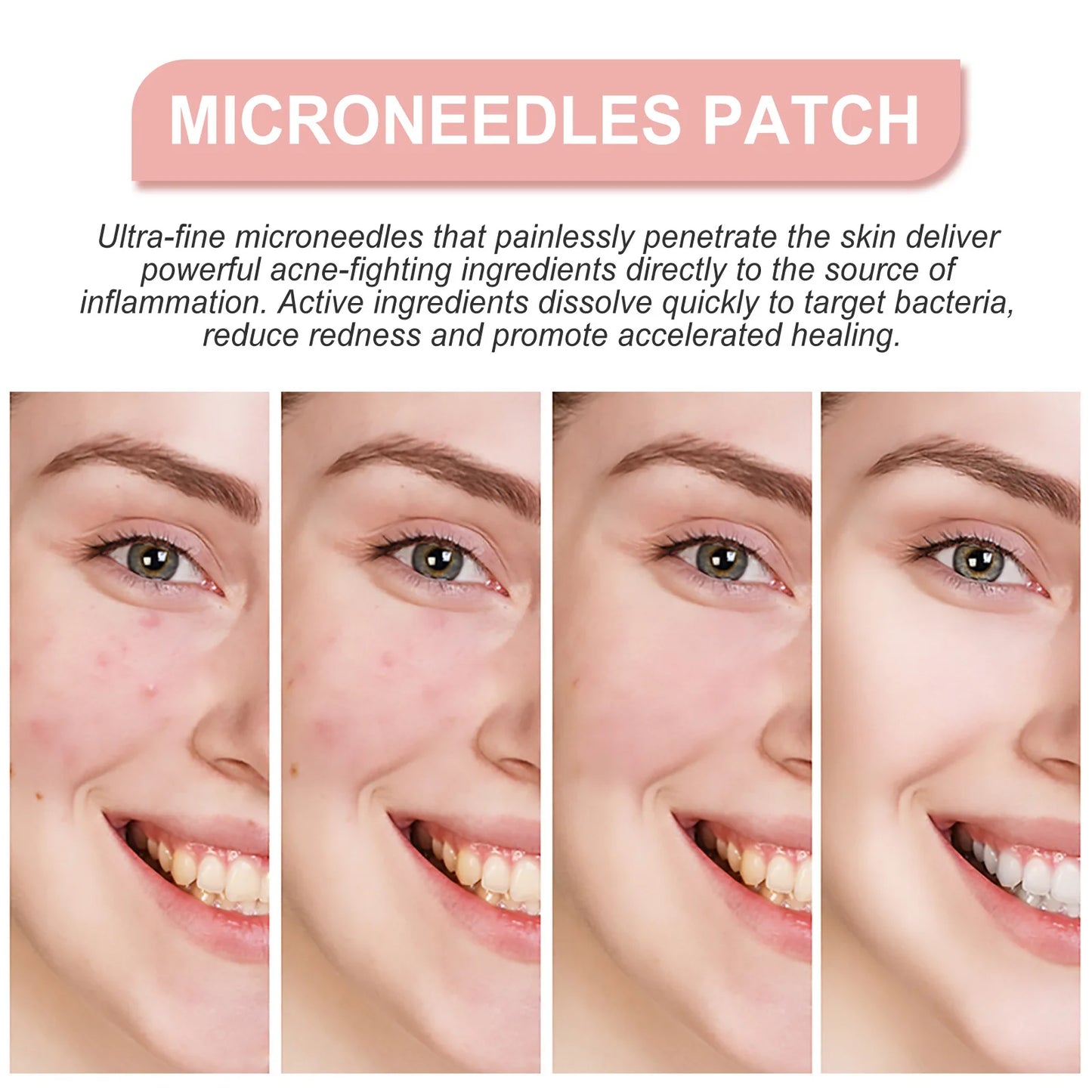 Face Patches for Pimples Microneedles Drying Patch Blemish Covering Stickers 72 Count Invisible Spot Care Absorbing All Day
